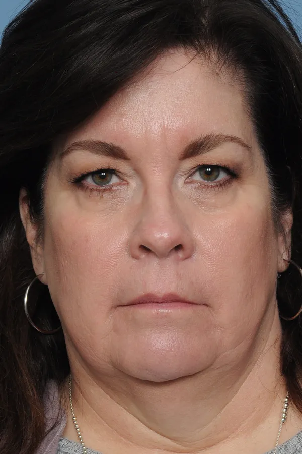 Dr. Givens Eyelid Lift 01