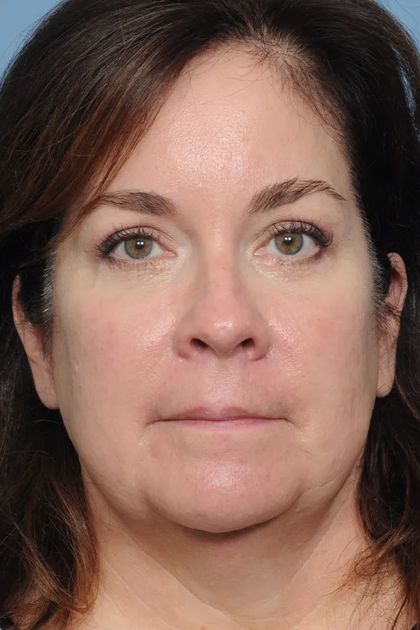 Dr. Givens Eyelid Lift 01