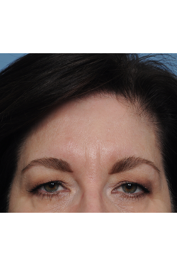 Eyelid Lift Before & After Gallery - Patient 8376631 - Image 3