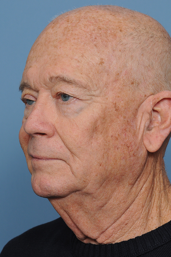 Brow Lift Before & After Gallery - Patient 8376515 - Image 5