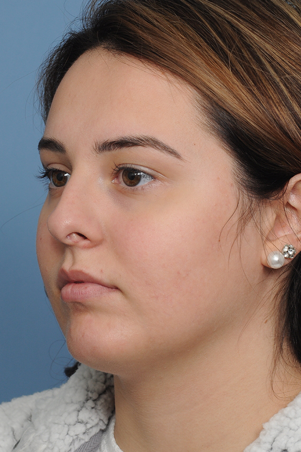 Rhinoplasty Before & After Gallery - Patient 8376727 - Image 5