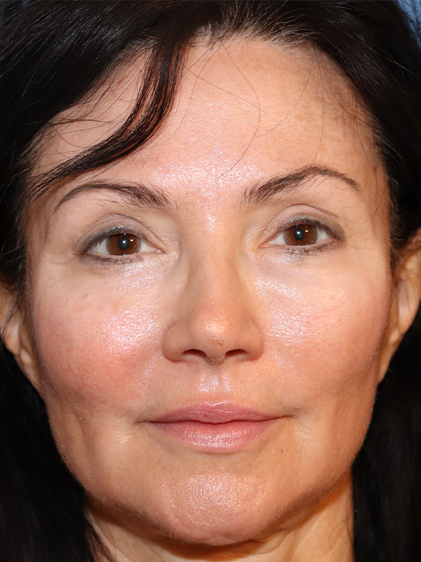 Cheek & Under Eye Filler Before & After Gallery - Patient 145843863 - Image 3