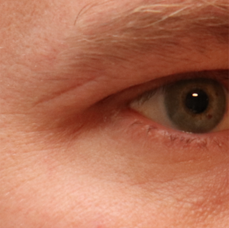 Microneedling Before & After Gallery - Patient 77040324 - Image 3