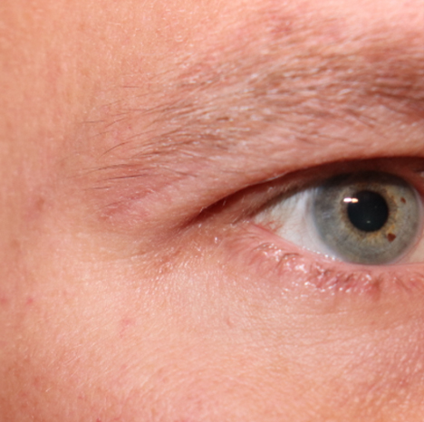 Microneedling Before & After Gallery - Patient 77040324 - Image 4