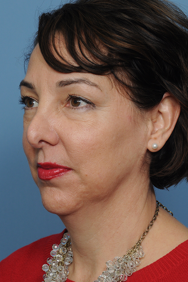 Chin Implant Before & After Gallery - Patient 12268216 - Image 5