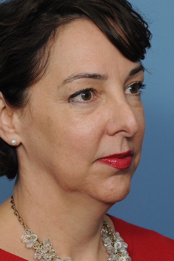 Chin Implant Before & After Gallery - Patient 12268216 - Image 9