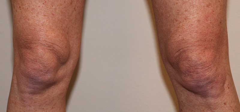 Microneedling Before & After Gallery - Patient 77040323 - Image 5