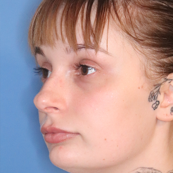 Lip Lift Before & After Gallery - Patient 77036732 - Image 3