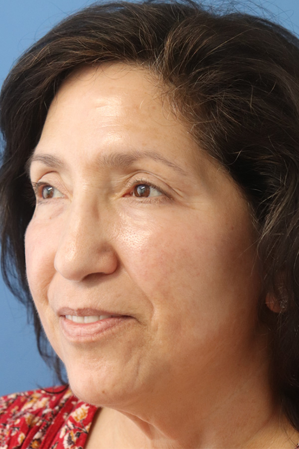 Eyelid Lift Before & After Gallery - Patient 145354791 - Image 3