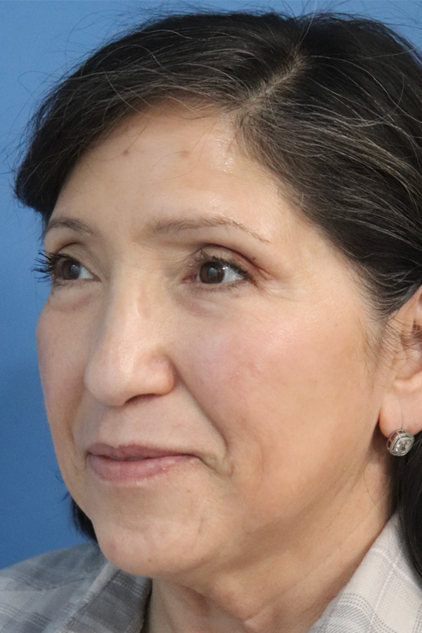 Eyelid Lift Before & After Gallery - Patient 145354791 - Image 4