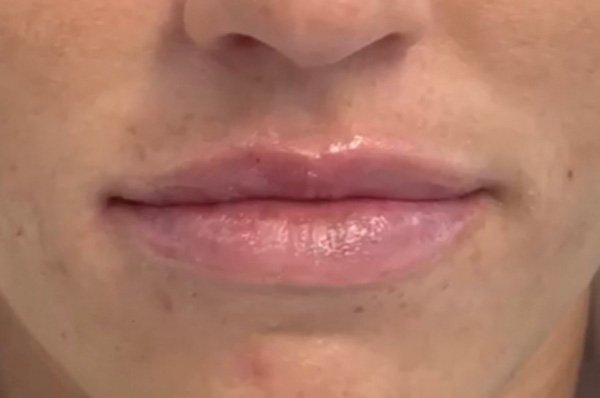 Lip Filler Before & After Gallery - Patient 152434081 - Image 2