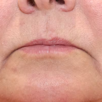 1687545834-7a-before