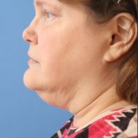 1699559741 2a before