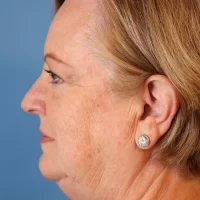 1699559768 3a before