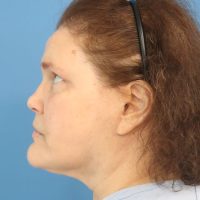 1699560004-5a-before