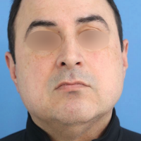 Buccal_Fat_patient_4c before