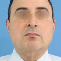 Buccal_Fat_patient_4c zafter