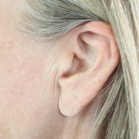 Earlobe-reduction-21a-before