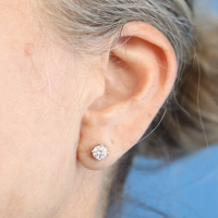 Earlobe-reduction-21a-zafter