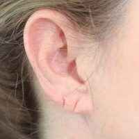 Earlobe-reduction-22a-before