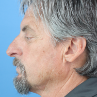 Rhinoplasty-11a-before