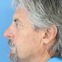 Rhinoplasty-11a-zafter