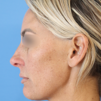 Rhinoplasty-12a-before