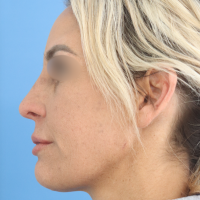 Rhinoplasty-12a-zafter