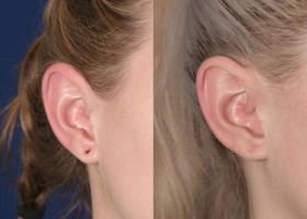 Surgical Earlobe Repair: The Step-by-Step Guide to Restoring Your Earlobes